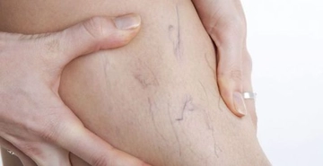 İbrahim Saraçoğlu Trombosit Düşüklüğü