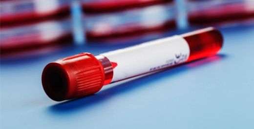 Trombosit Testi Nedir ve Nasıl Yapılır?